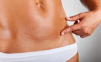 Narbenbildungen nach einer Operation am Bauch können durch eine Narbenkorrektur entfernt werden.