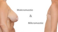 Makromastie und Mikromastie stellen Brustfehlbildungen dar
