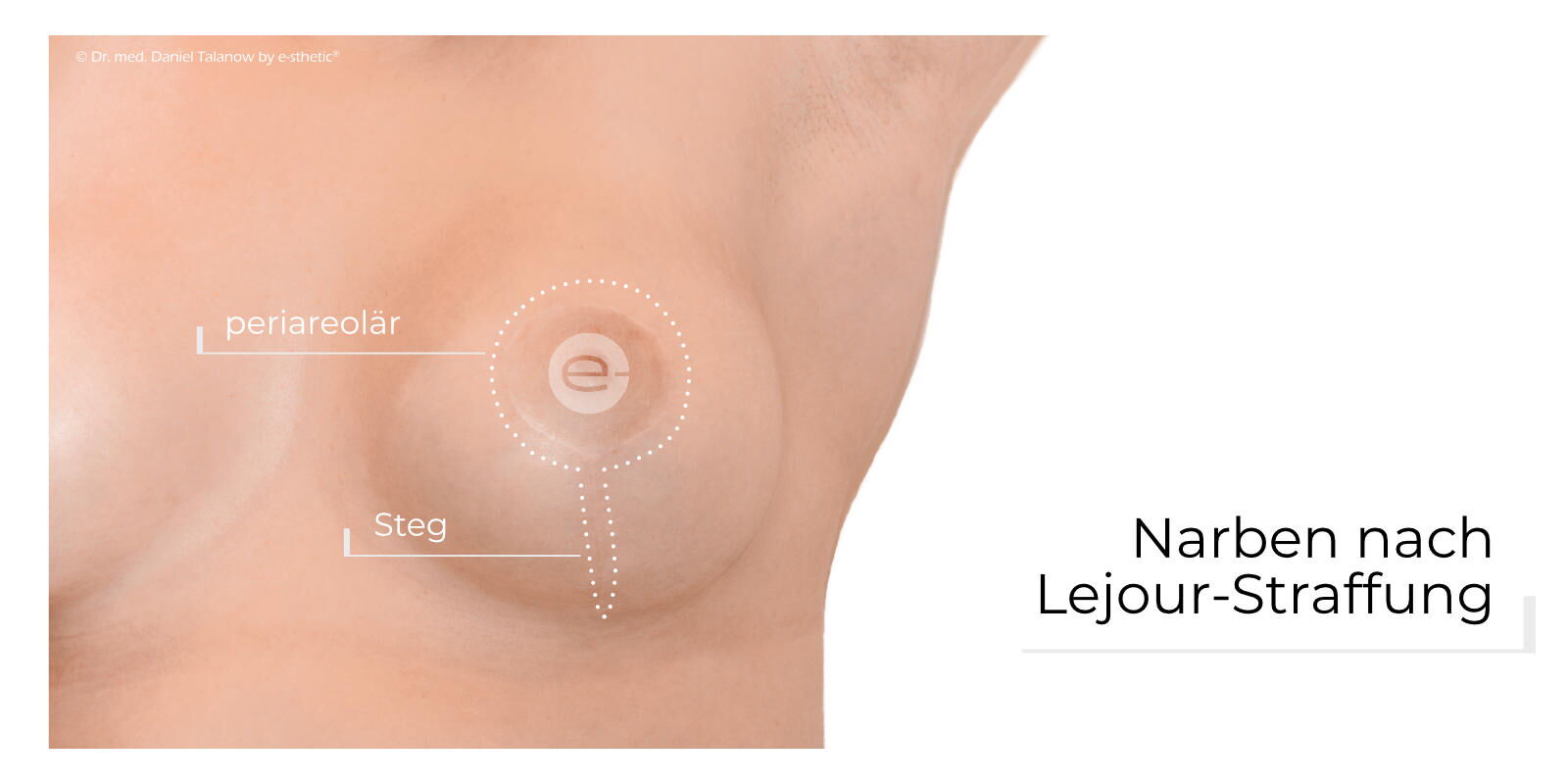 Die Lejour-Technik ist eine spezielle narbensparende Operationsmethode bei einer Verkleinerung sowie Straffung von Brüsten