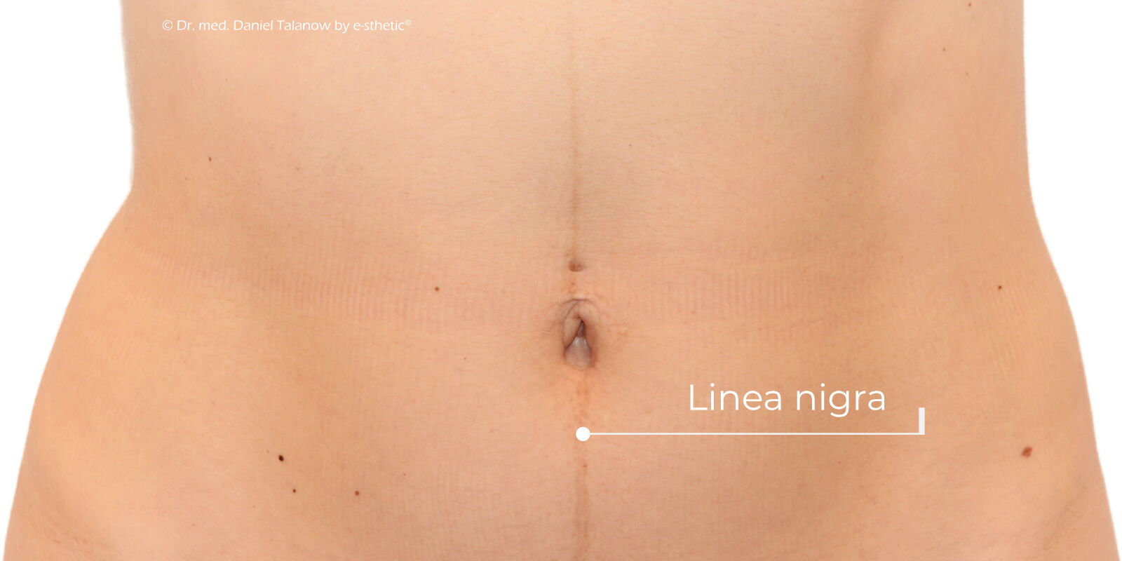 Während der Schwangerschaft kann es durch Hormonumstellungen lokal an der Bauchwand zu einer senkrecht ausgerichteten und pigmentierten Linie kommen, welche als Linea nigra bezeichnet wird