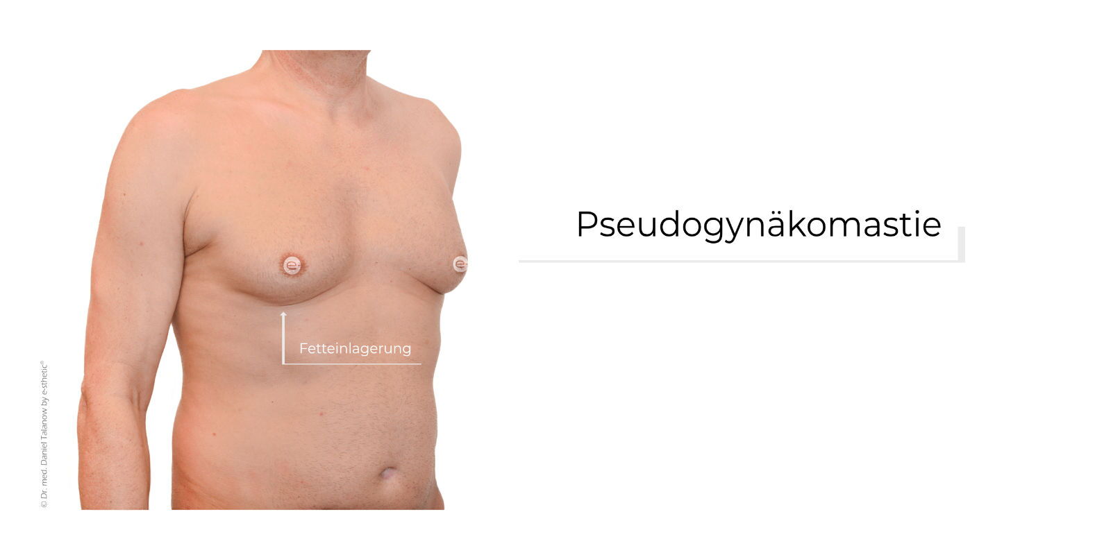Eine Pseudogynäkomastie ist eine übermäßige Fettansammlung an der männlichen Brust