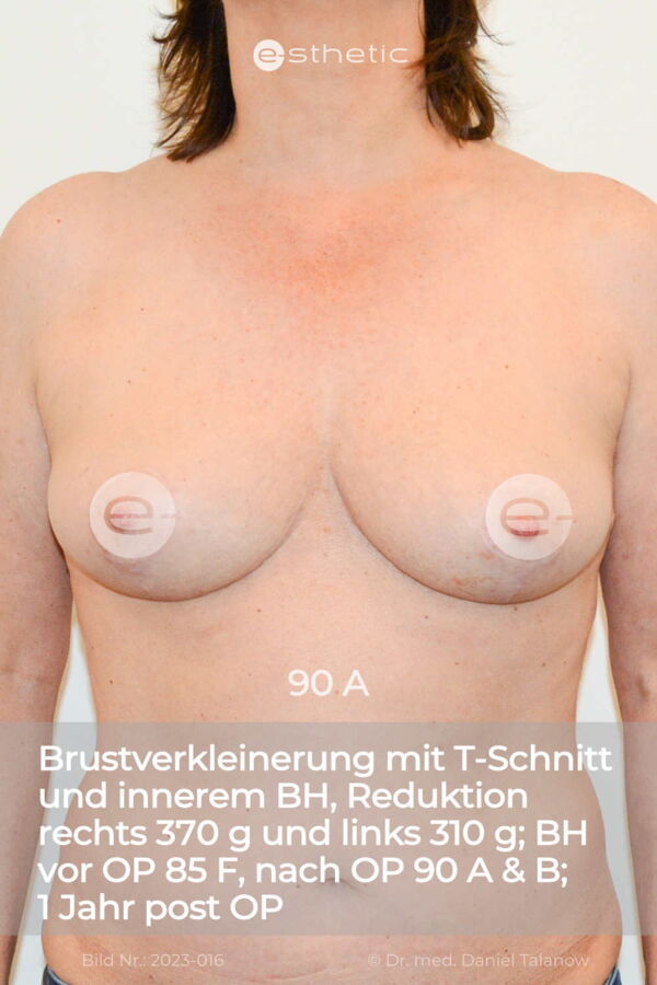 Eine Brustverkleinerung mit T-Schnitt auf 90 A circa 1 Jahr post OP
