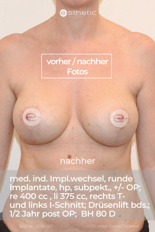 Nachher-Foto nach einem medizinisch indizierten Implantatwechsel