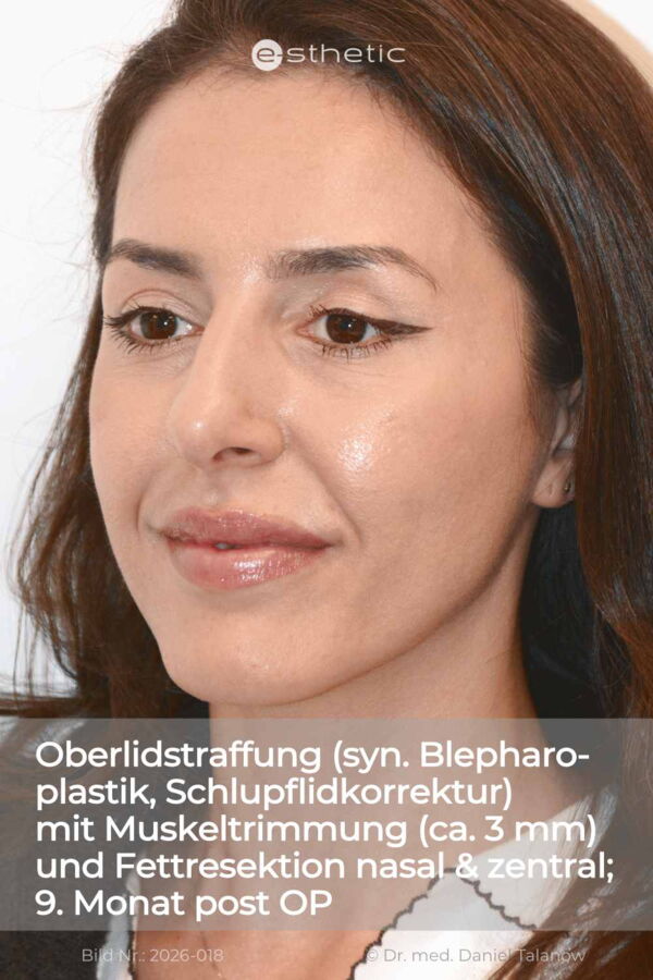 Dieses Nachher-Foto zeigt das Ergebnis einer Schlupflidkorrektur, etwa 6 Monate post OP