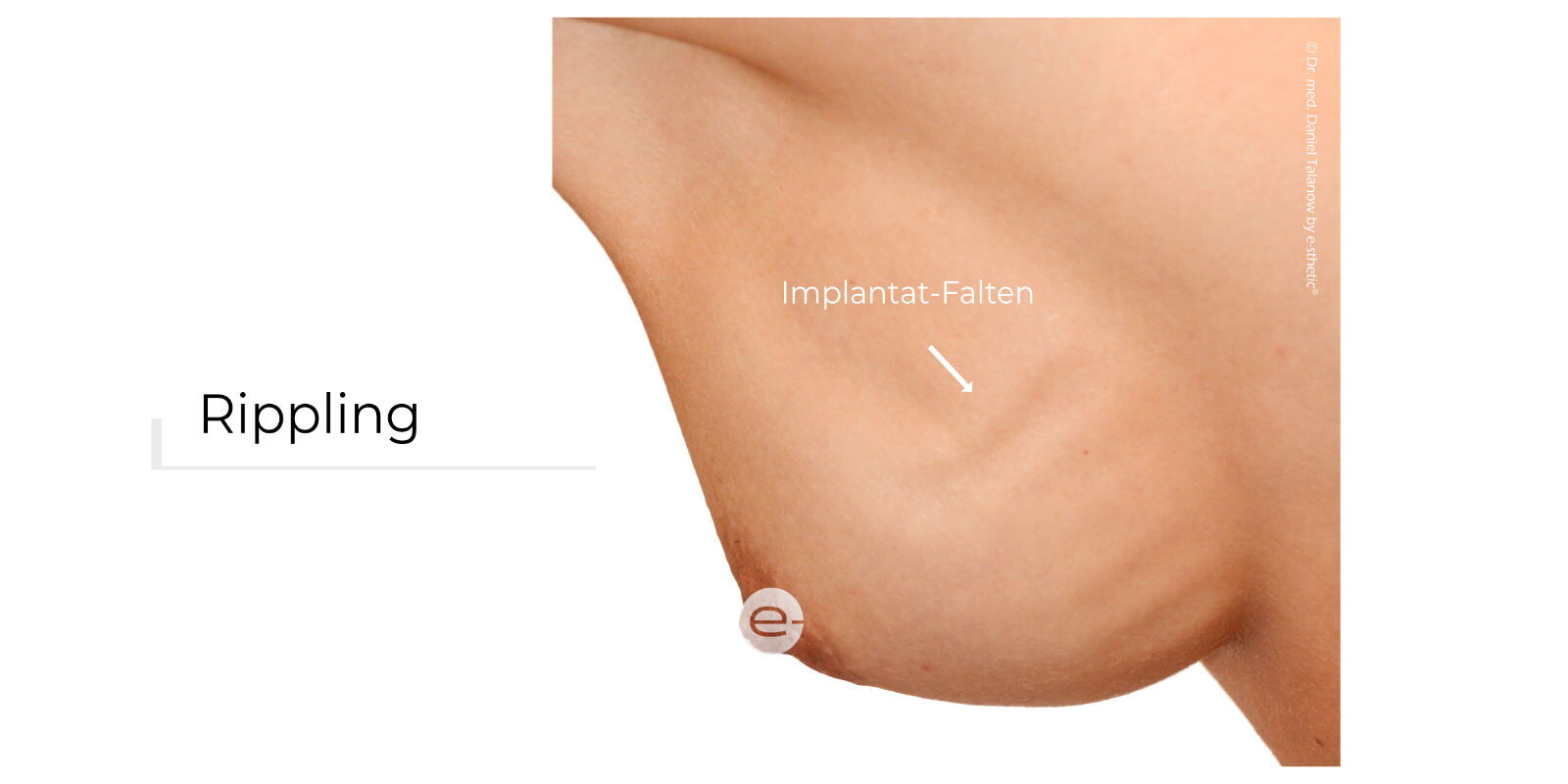 Rippling beschreibt die tastbare und teils sichtbare Faltenbildung eines Brustimplantates nach einer Brustvergrößerung