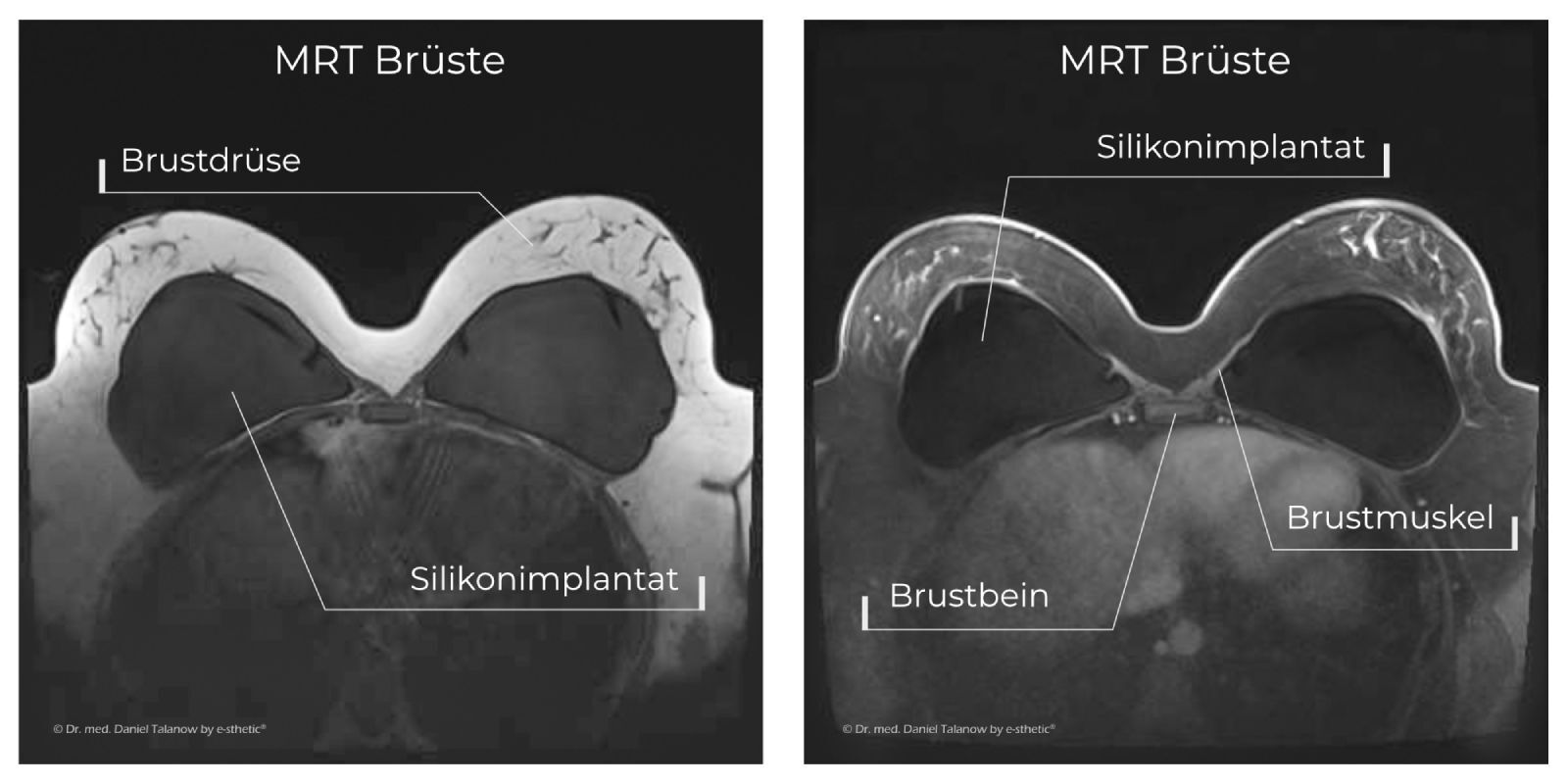 Die Abkürzung MRT steht für "Magnetresonanztomographie"