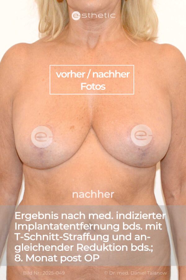 Nachher-Fotos nach einer ästhetisch indizierten Implantatentfernung