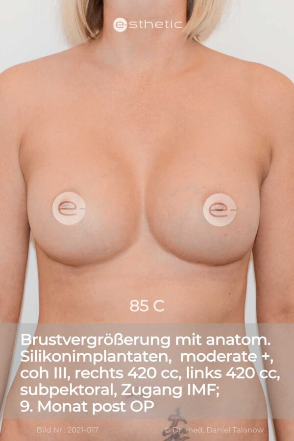 Nachher-Foto einer Brustvergrößerung mit anatomischen Silikonimplantaten auf 85 C