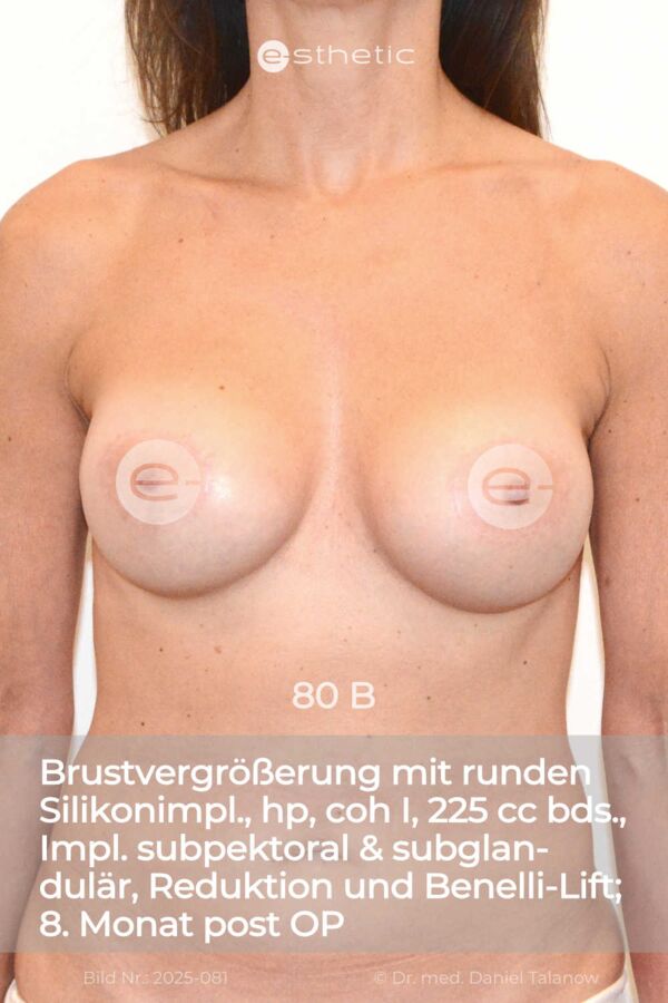 Nachher-Foto einer Bruststraffung der Vorhöfe mit gleichzeitiger Brustvergrößerung und Reduktion