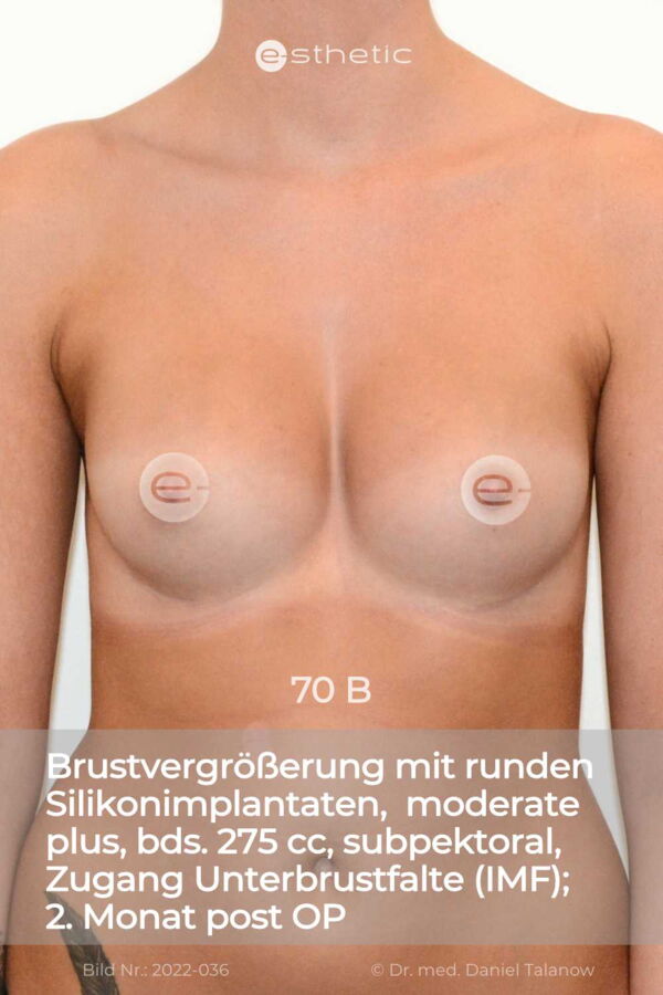 Nachher-Aufnahme einer Brustvergrößerung mit runden Silikonimplantaten