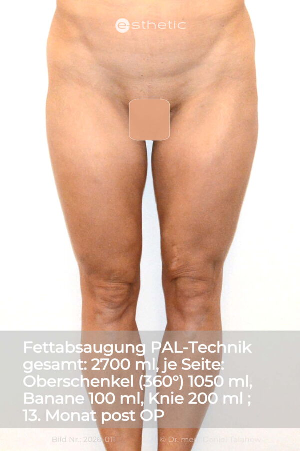 Nachher-Foto einer Fettabsaugung, circa 15 Monate nach dem Eingriff