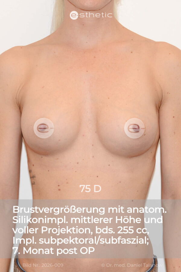 Dieses Foto zeigt das Resultat einer Brustvergrößerung mit anatomischen Silikonimplantaten von 85 A auf 80 C