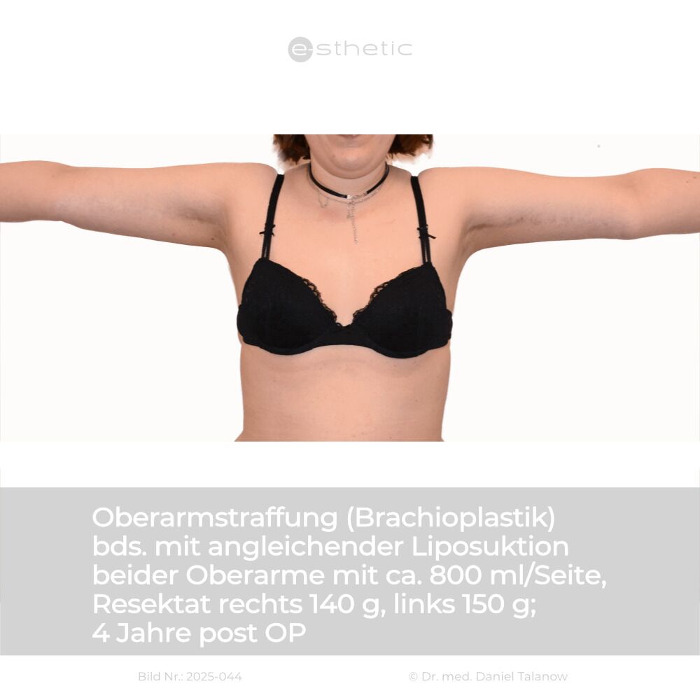 Nachher-Foto einer Oberarmstraffung mit angleichender Liposuktion