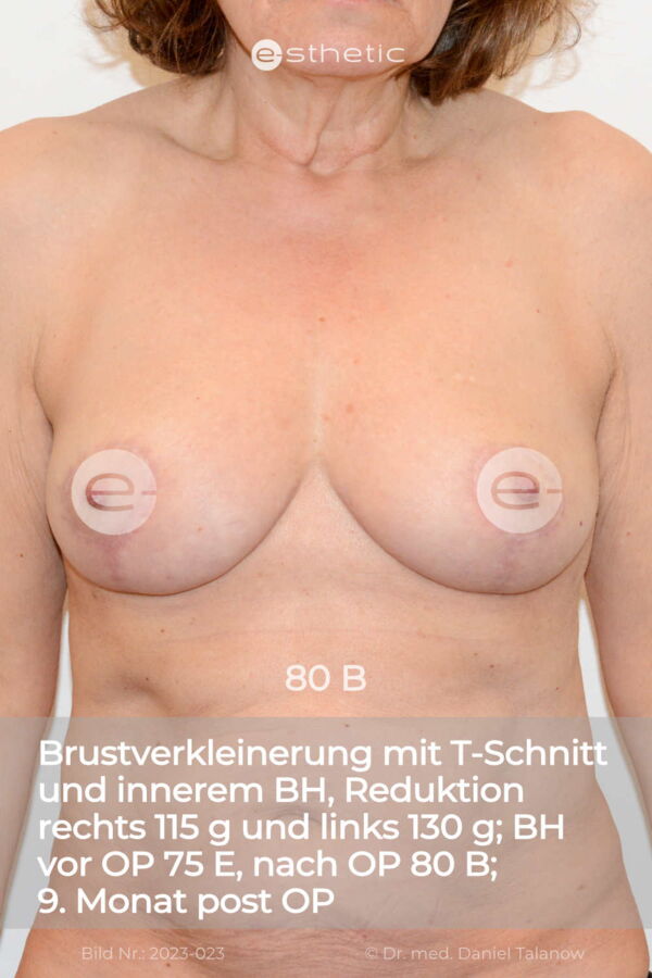 Brustverkleinerung mit T-Schnitt auf 80 B