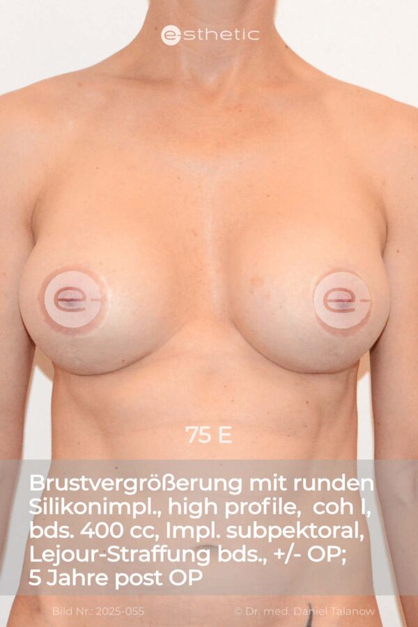 Nachher-Foto einer Bruststraffung der Vorhöfe mit gleichzeitiger Brustvergrößerung und Reduktion