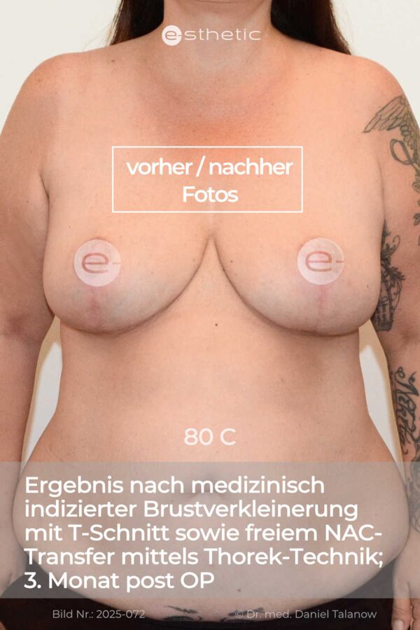 Hier zeigen wir ein sehr natürliches Ergebnis 3 Monate nach einer komplexen Brustverkleinerung bei medizinischer Indikation. Viele Weitere Behandlungsergebnisse finden Sie im Menü unter "Ergebnisse" .