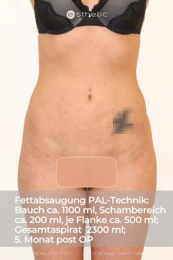 Nachher-Foto einer Fettabsaugung, circa 15 Monate nach dem Eingriff