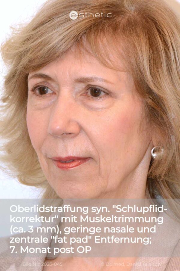 Nachher-Foto einer klassischen Oberlidstraffung mit geringer Fettentfernung, circa 6 Monate nach dem Eingriff