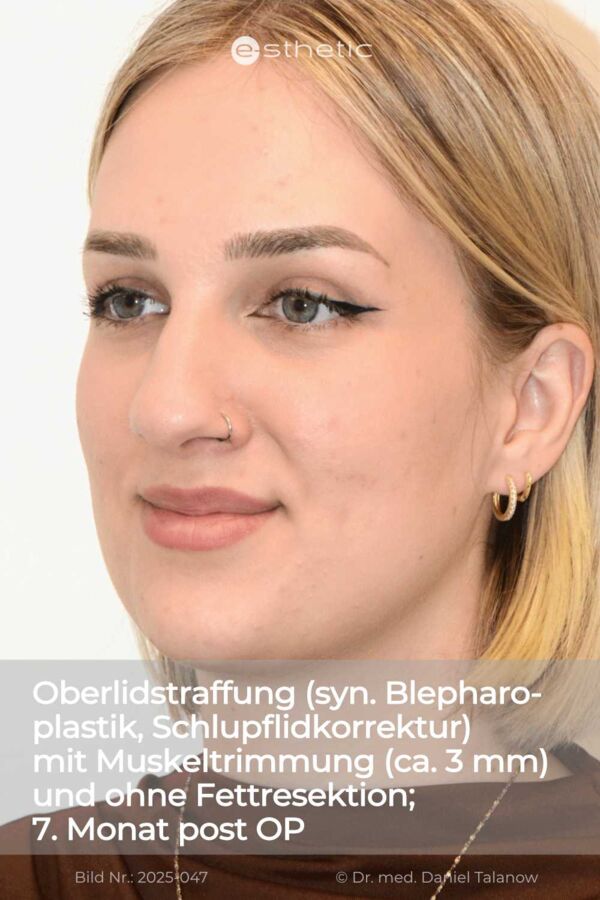 Dieses Nachher-Foto zeigt das Ergebnis einer Schlupflidkorrektur, etwa 6 Monate post OP