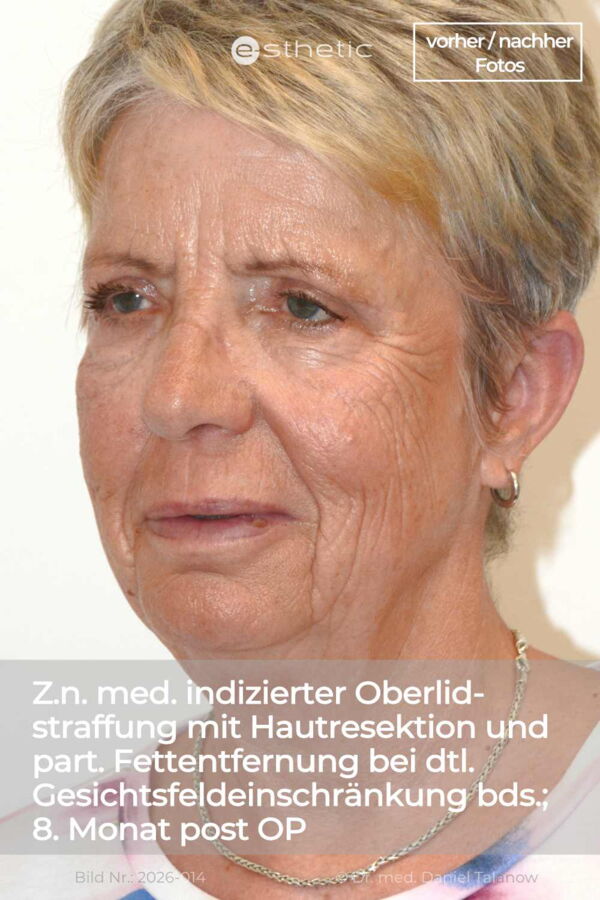 Ergebnis einer medizinisch indizierten, beidseitigen Oberlid-Blepharoplastik
