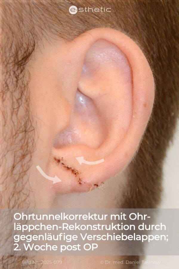 Ergebnis einer Gynäkomastie, circa 1,5 Jahre nach dem Eingriff