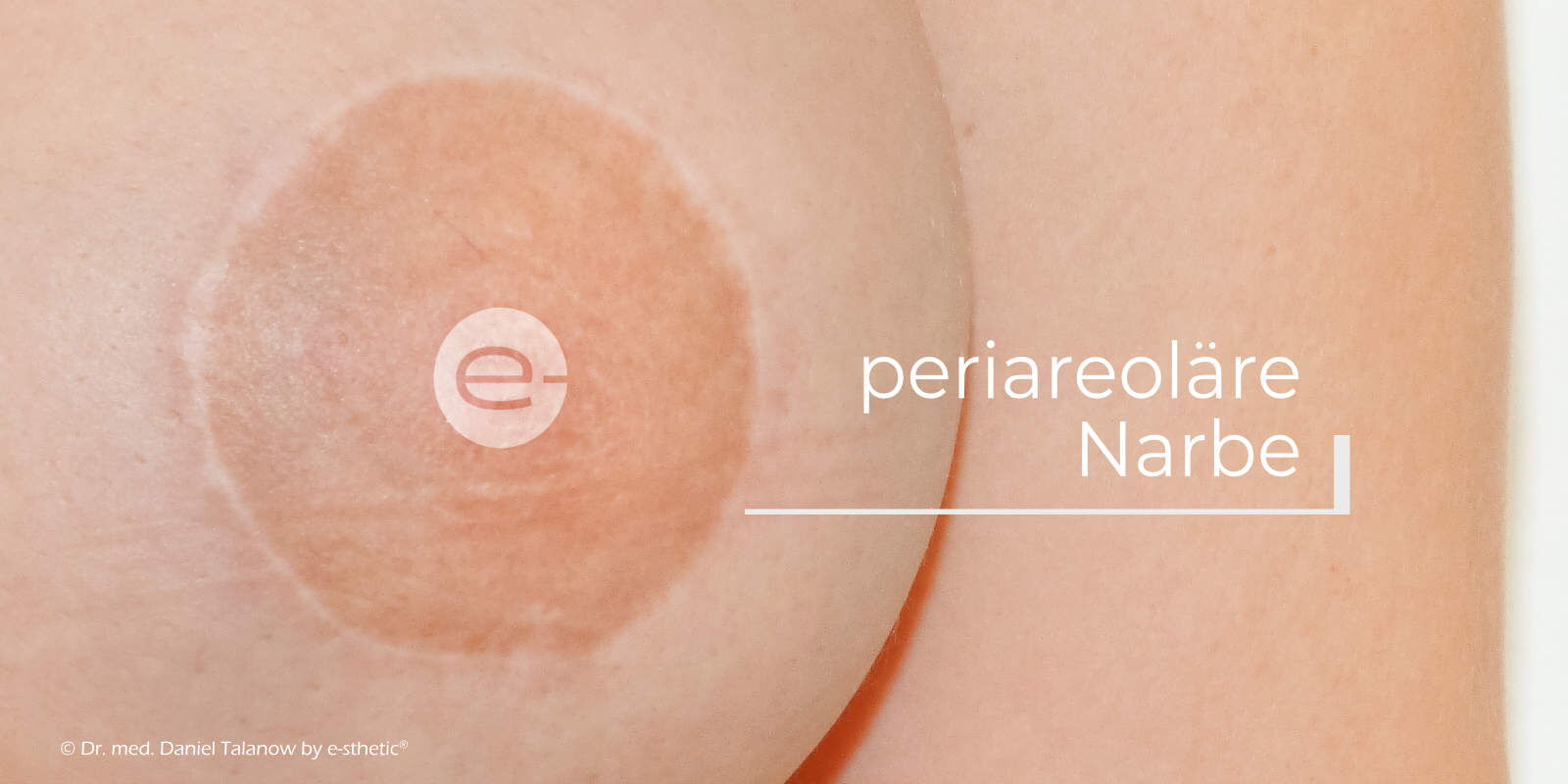 Eine periareoläre Straffung ist eine ringförmige Verkleinerung des Brustwarzenvorhofes
