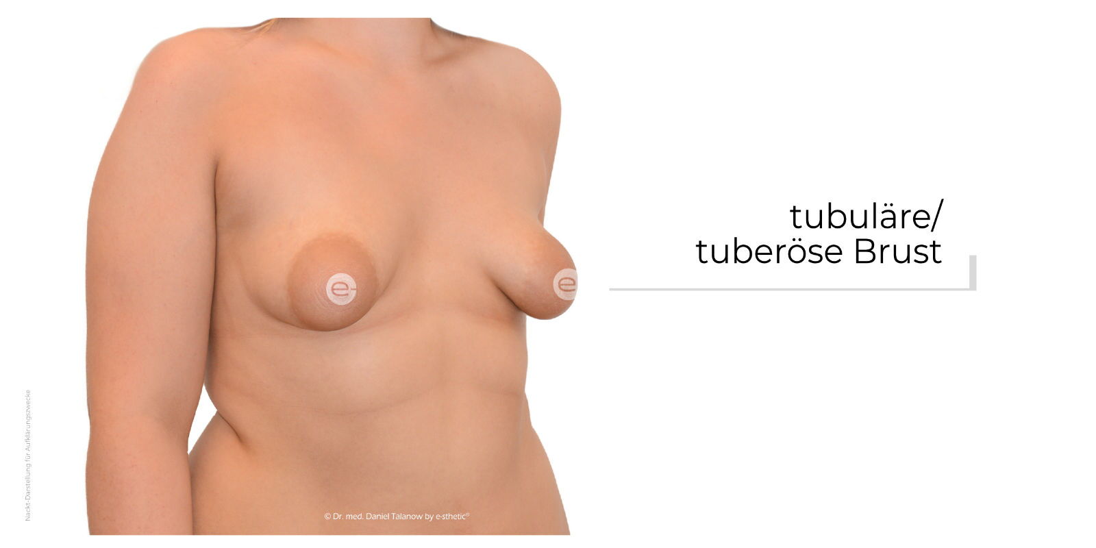 Die tubuläre Brust beschreibt eine Fehlbildung der weiblichen Brust