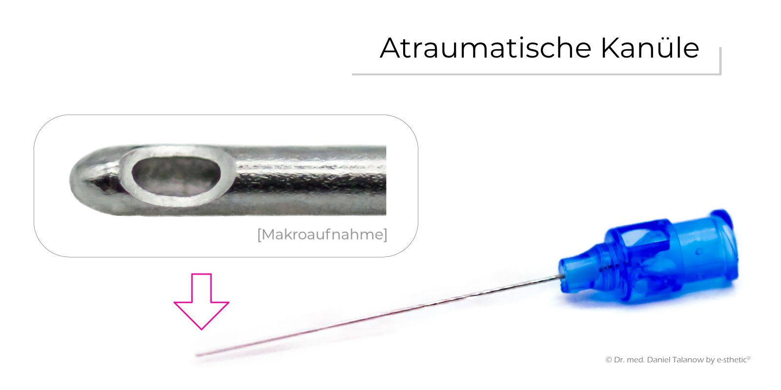 Atraumatische Kanülen für schönste Ergebnisse bei Unterspritzungen mit Hyaluronsäure