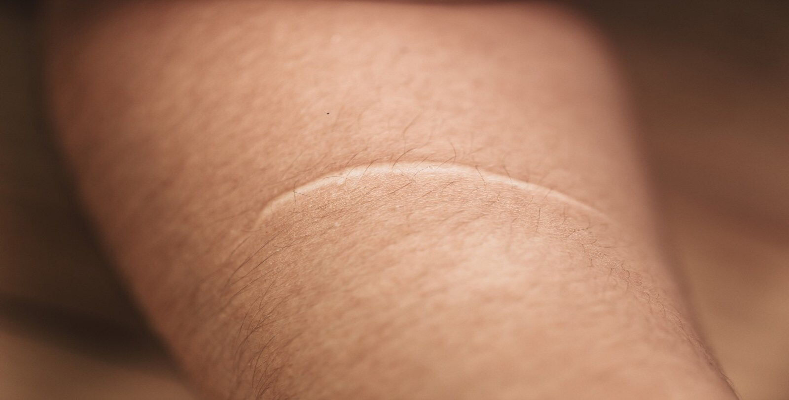 Narbenkorrektur in Essen - Eine Narbe auf dem Arm kann operativ entfernt werden.