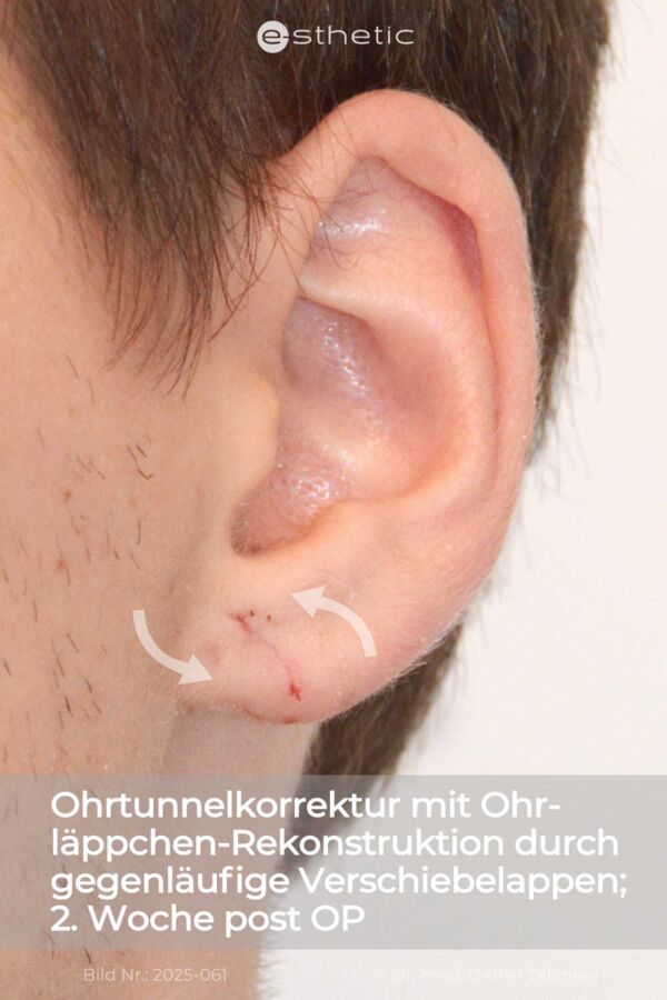 Ergebnis einer Gynäkomastie, circa 1,5 Jahre nach dem Eingriff