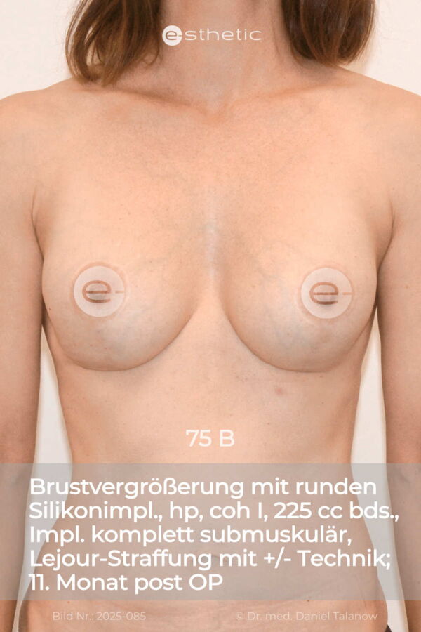 Nachher-Foto einer Bruststraffung der Vorhöfe mit gleichzeitiger Brustvergrößerung und Reduktion