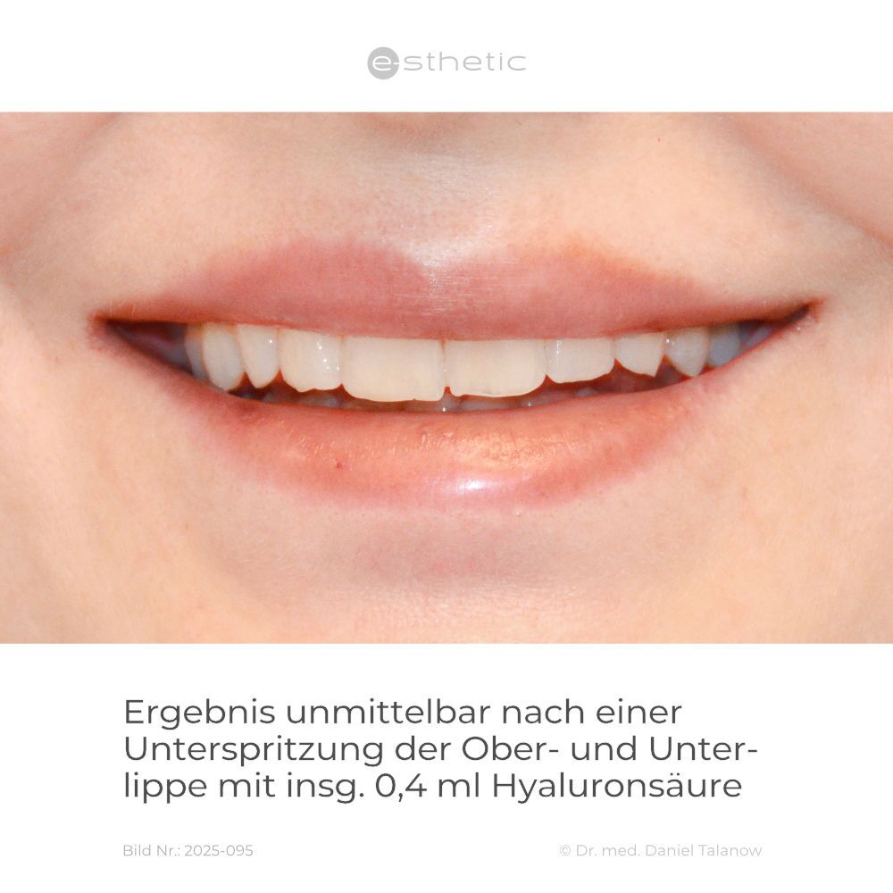 Dieses Foto zeigt das Ergebnis einer Unterspritzung der Ober- und Unterlippe circa 4 Monate nach dem Eingriff
