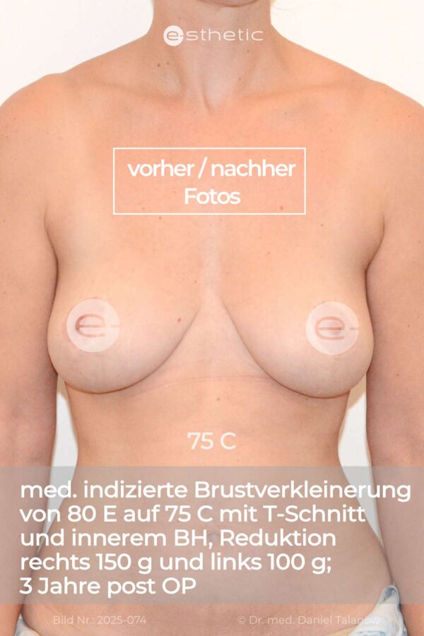 Haeder-Nachher-Foto nach einer medizinisch indizierten Brustverkleinerung mit dem T-Schnitt in unserer e-sthetic Privatklinik in Essen!