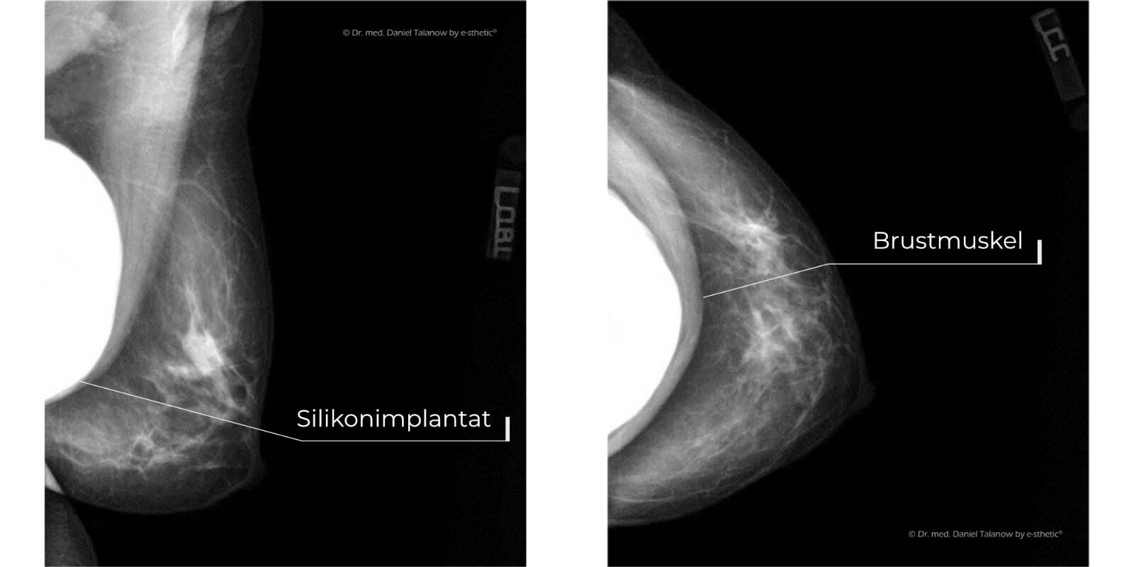 Die Mammographie ist eine spezielle Röntgenuntersuchung der Brust und wird zur Brustkrebsfrüherkennung eingesetzt