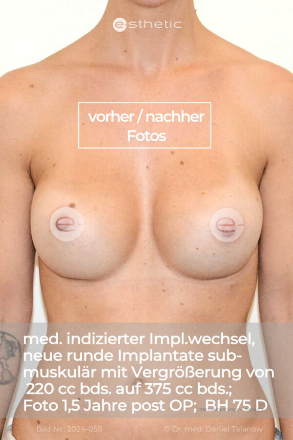 Nachher-Foto nach einem Implantatwechsel bei Kapselfibrose, Implantatdefekt und Implantatdislokation