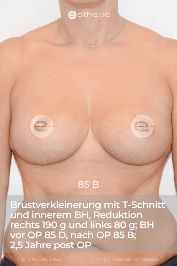 Das Ergebnis einer Brustverkleinerung mit T-Schnitt auf 85 B