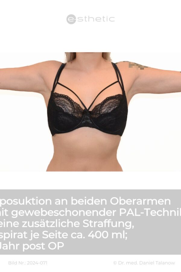 Nachher-Foto einer Fettabsaugung, circa 15 Monate nach dem Eingriff