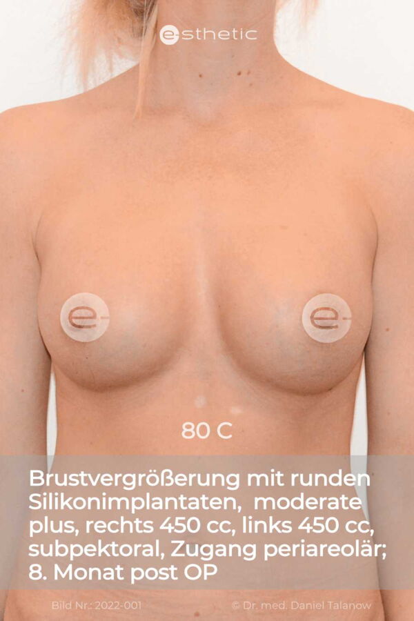 Brustvergrößerung mit runden Silikonimplantaten von 85 B auf 80 C