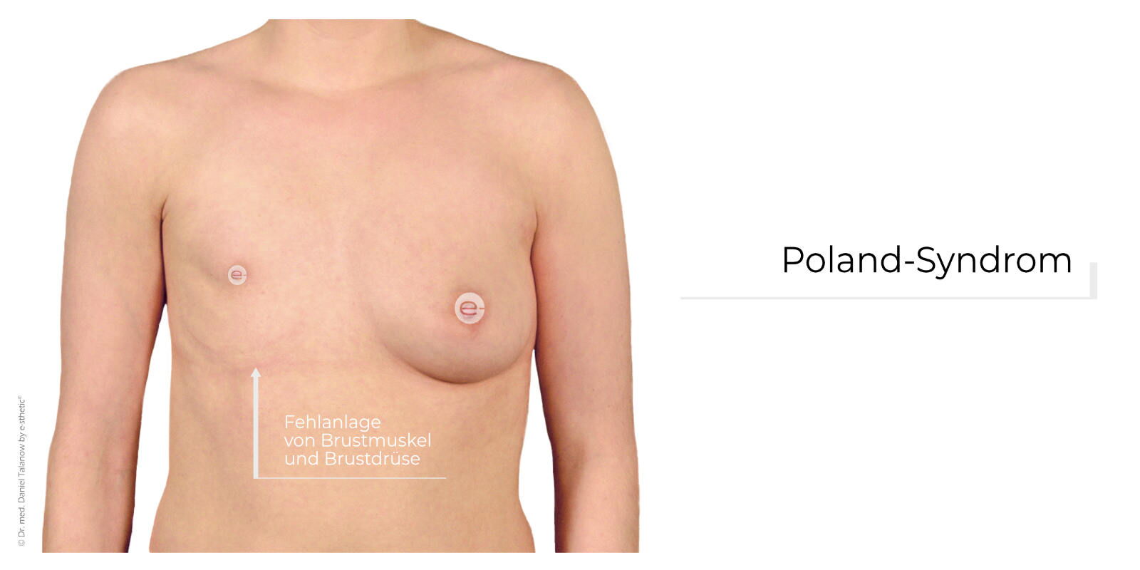Von einem Poland-Syndrom wird gesprochen, wenn sowohl die Brustdrüse als auch der M. pectoralis major (großer Brustmuskel) nicht ausgebildet sind