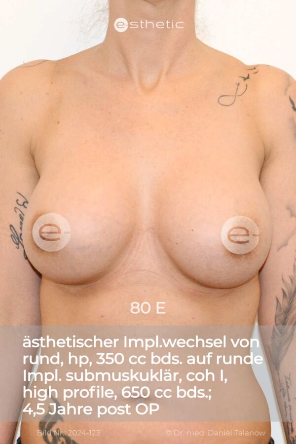 Nachher-Foto nach einem ästhetisch indizierten Implantatwechsel, circa 8 Jahre nach dem Eingriff