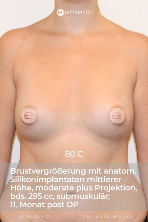 Dieses Foto zeigt das Resultat einer Brustvergrößerung mit anatomischen Silikonimplantaten von 85 A auf 80 C