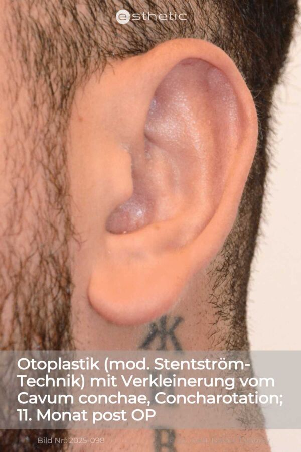 Ergebnis einer Gynäkomastie, circa 1,5 Jahre nach dem Eingriff