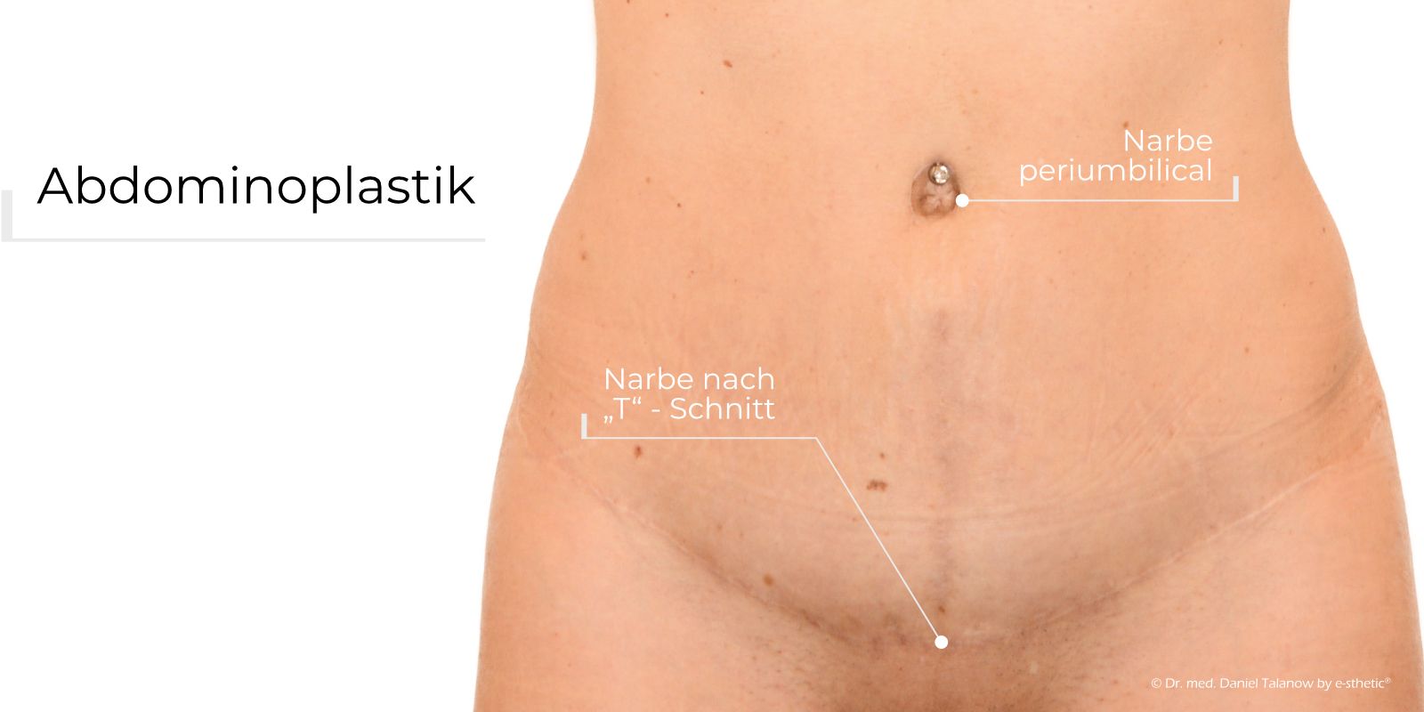 Unter einer Abdominalplastik versteht man eine Bauchdeckenplastik oder Bauchdeckenstraffung.