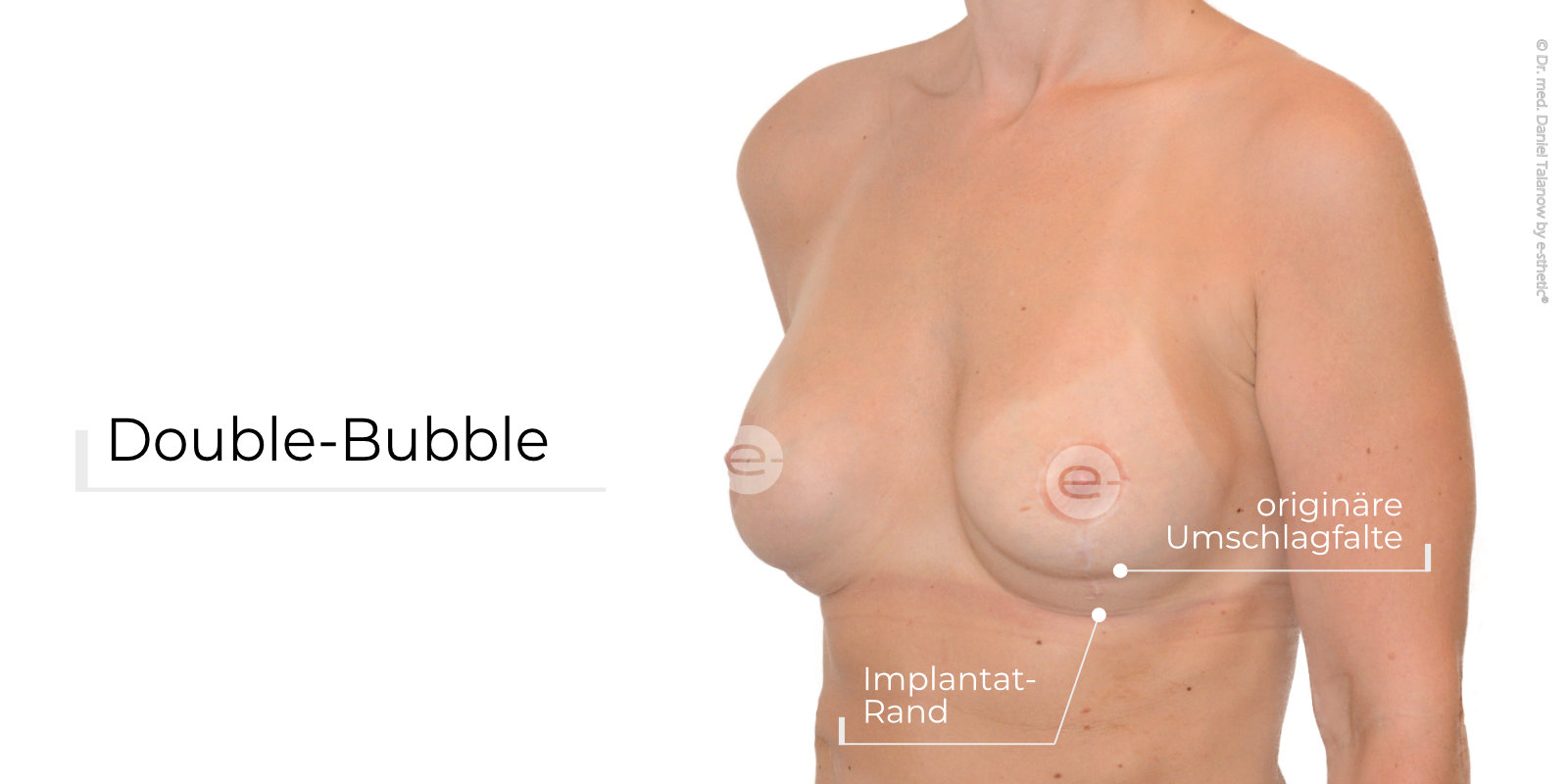 Beispiel einer Double-Bubble nach Brustvergrößerung