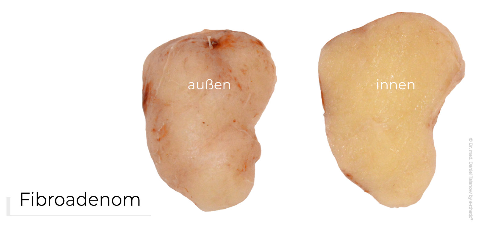 Außen- und Innenansicht eines Fibroadenom