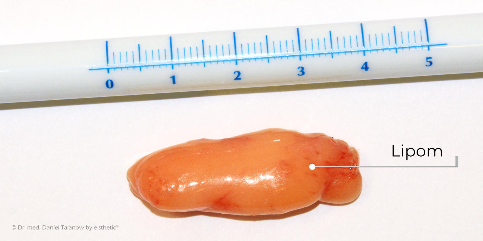 Das dargestellte Lipom verursachte beim Patienten deutliche Druckschmerzen, weshalb er sich für eine komplette Entfernung des Lipoms entschloss.
