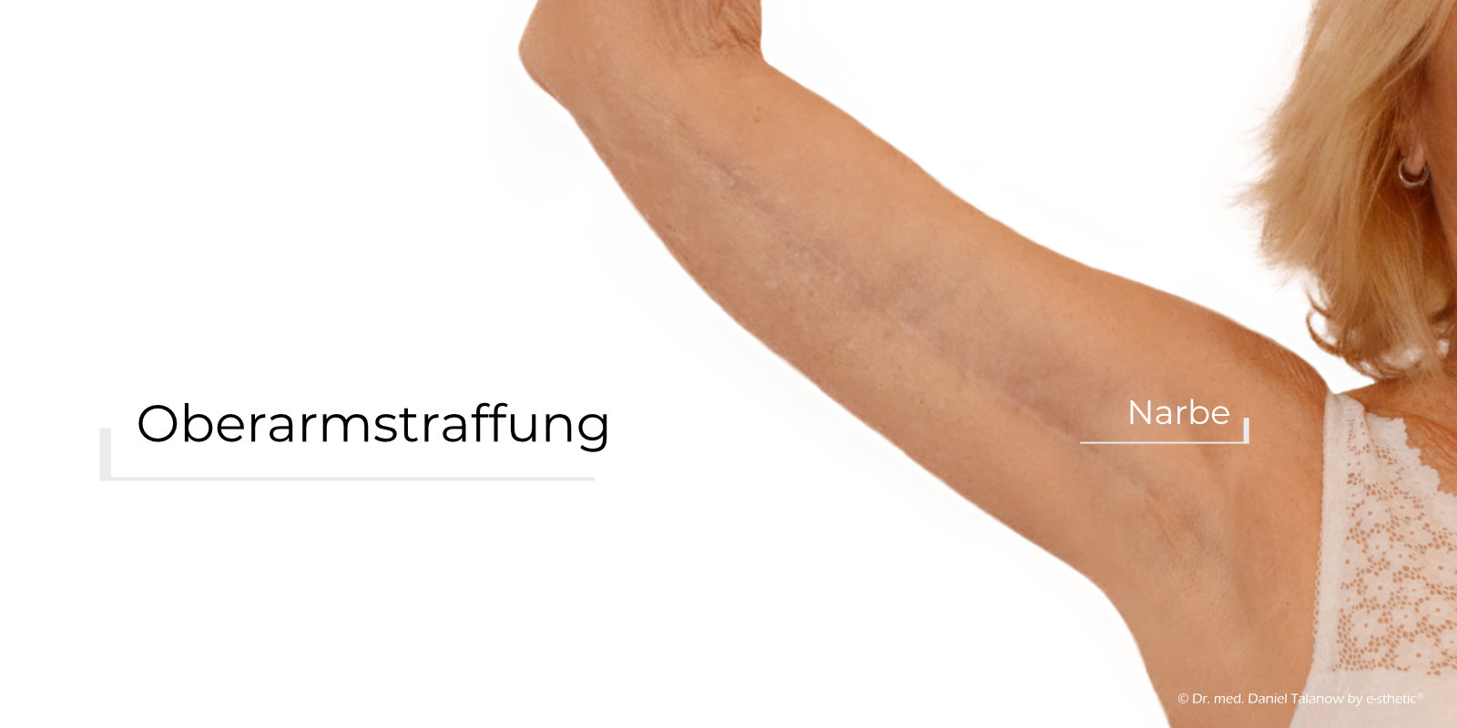 Ergebnis einer Oberarmstraffung durchgeführt in der e-sthetic® Klinik